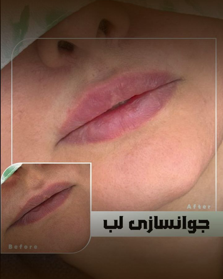 نمونه کار مژگان صالحی — لیفت و لمینت مژه