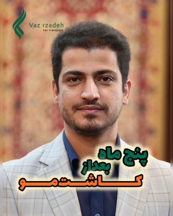 نمونه کار مینا وزیرزاده — لیفت و لمینت مژه