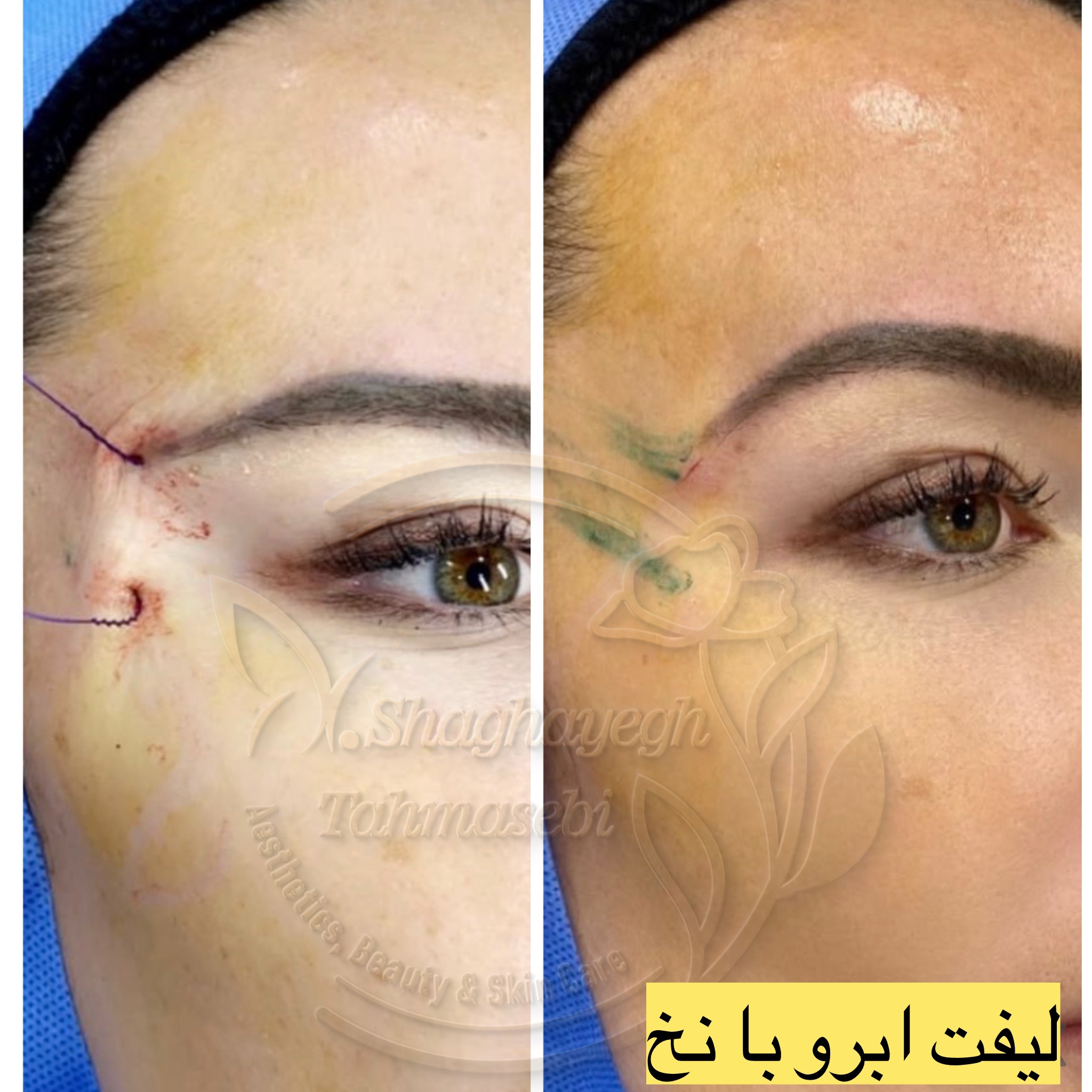 نمونه کار دکتر شقایق طهماسبی — لیفت و لمینت مژه