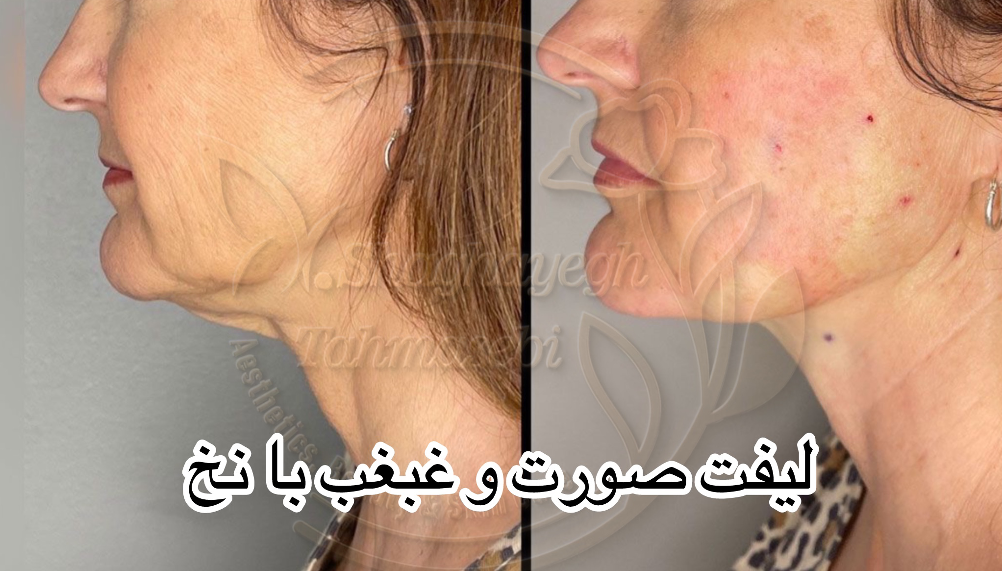 نمونه کار دکتر شقایق طهماسبی — لیفت و لمینت مژه