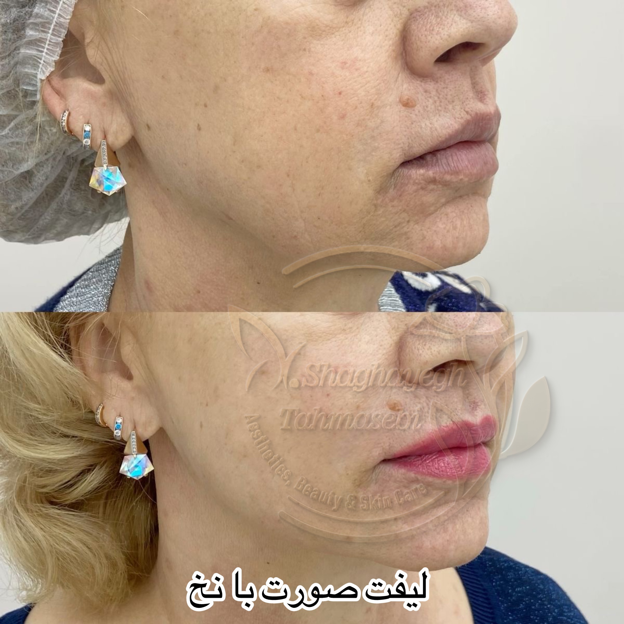نمونه کار دکتر شقایق طهماسبی — لیفت و لمینت مژه