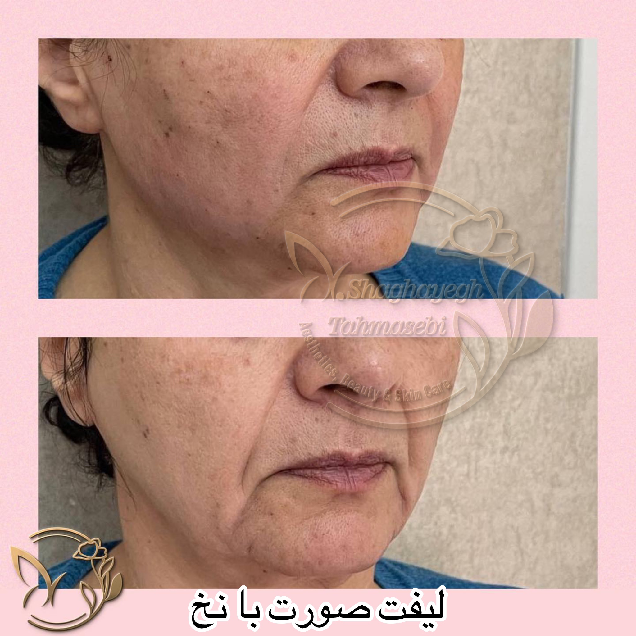 نمونه کار دکتر شقایق طهماسبی — لیفت و لمینت مژه