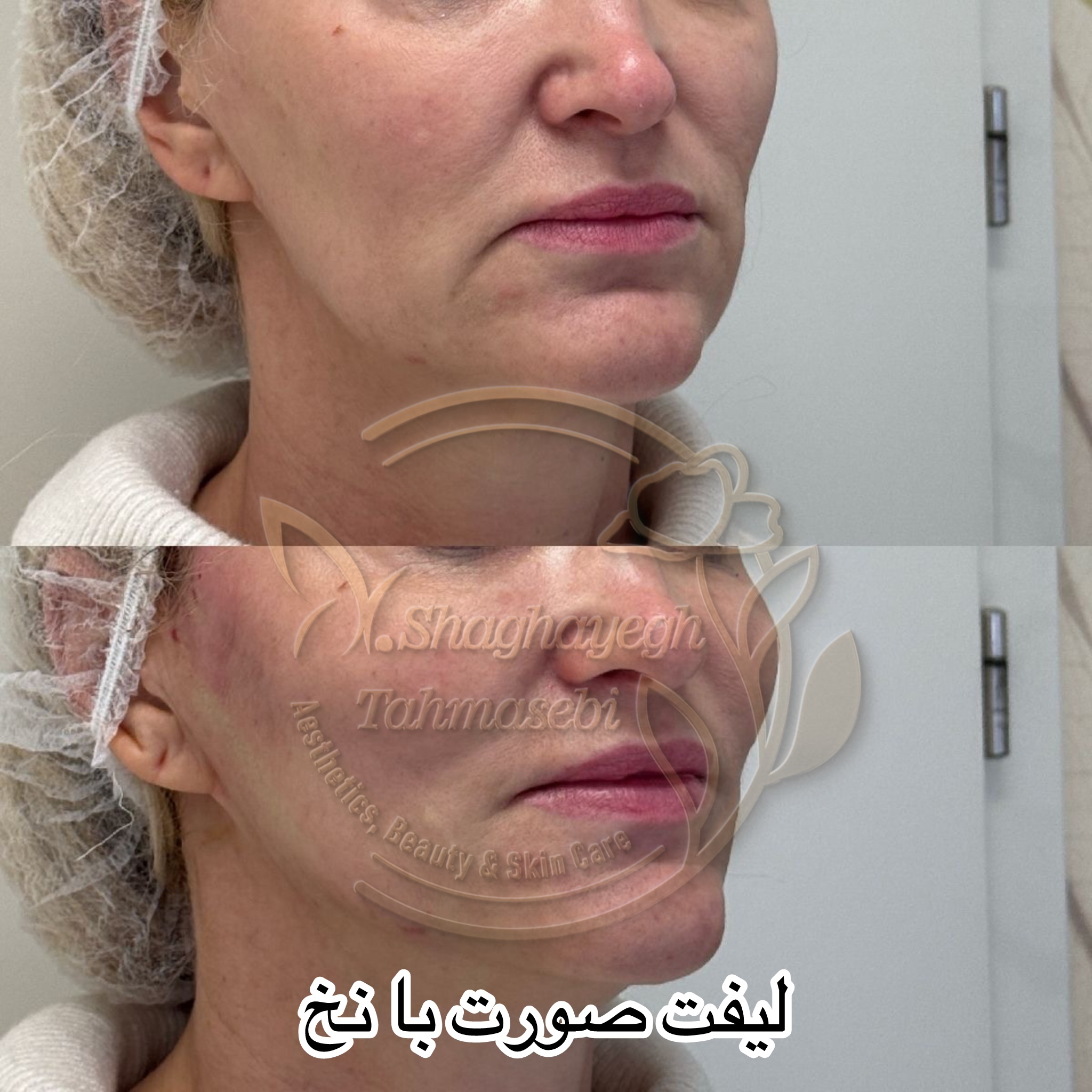 نمونه کار دکتر شقایق طهماسبی — لیفت و لمینت مژه
