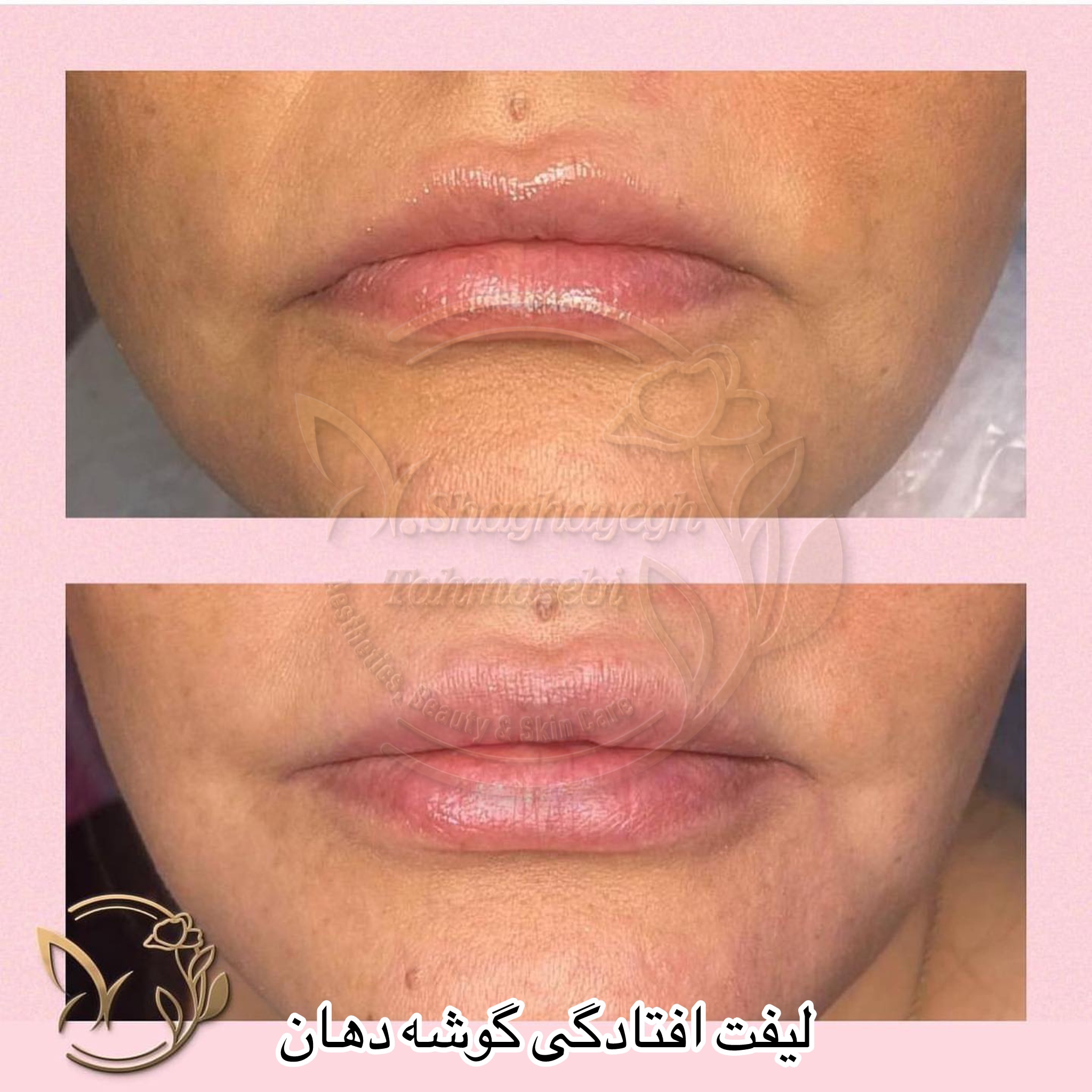 نمونه کار دکتر شقایق طهماسبی — لیفت و لمینت مژه