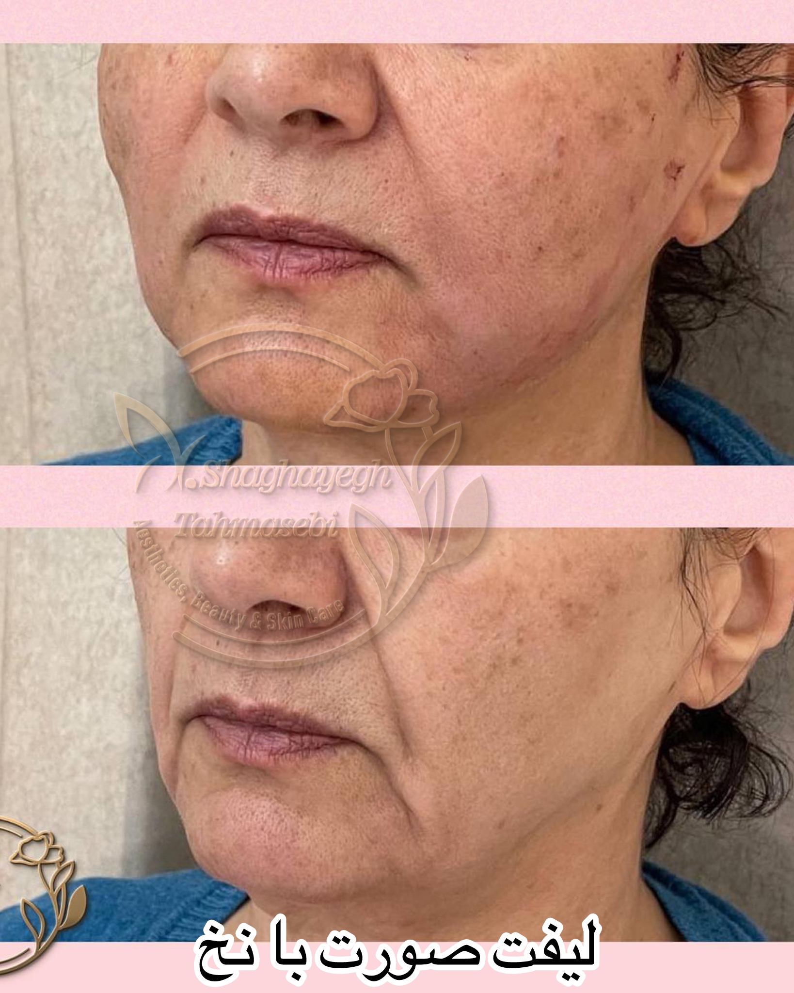 نمونه کار دکتر شقایق طهماسبی — لیفت و لمینت مژه