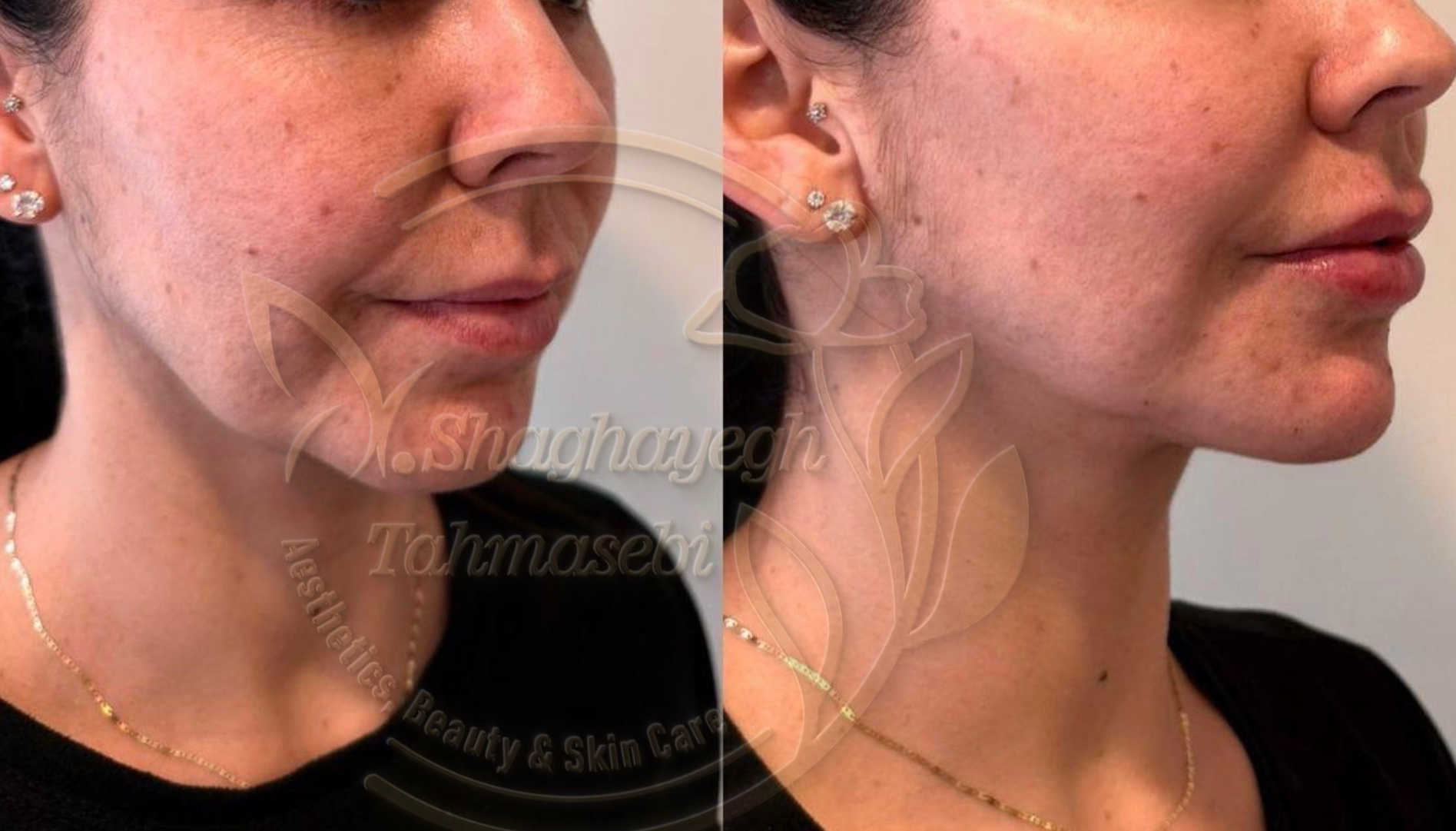 نمونه کار دکتر شقایق طهماسبی — لیفت و لمینت مژه