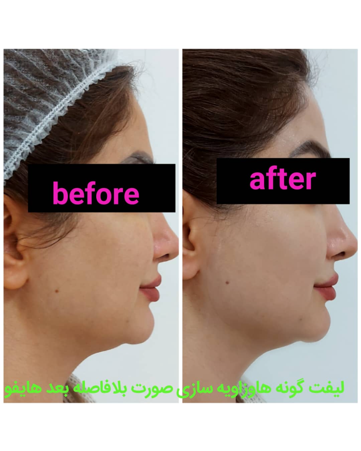 نمونه کار مهشید ذاکری — لیفت و لمینت مژه