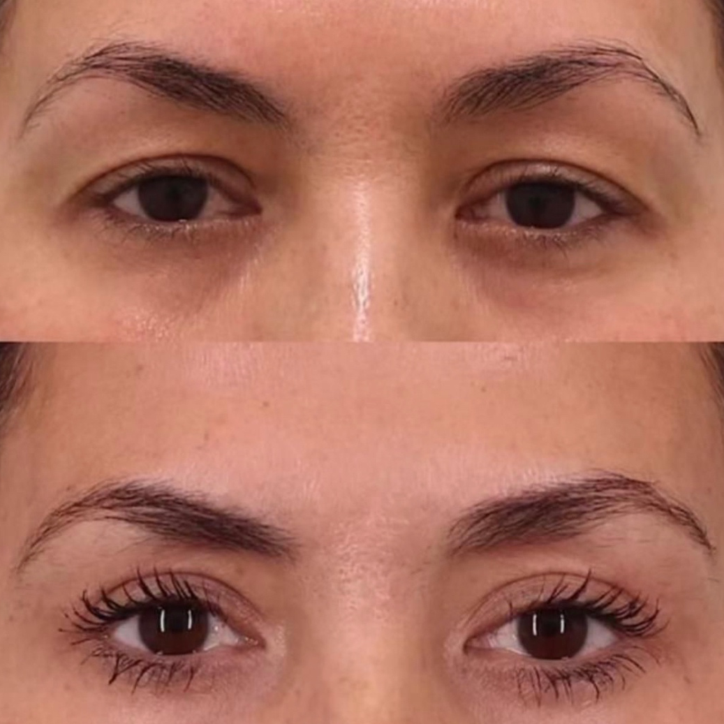نمونه کار دکتر مسعود افتابی — لیفت و لمینت مژه