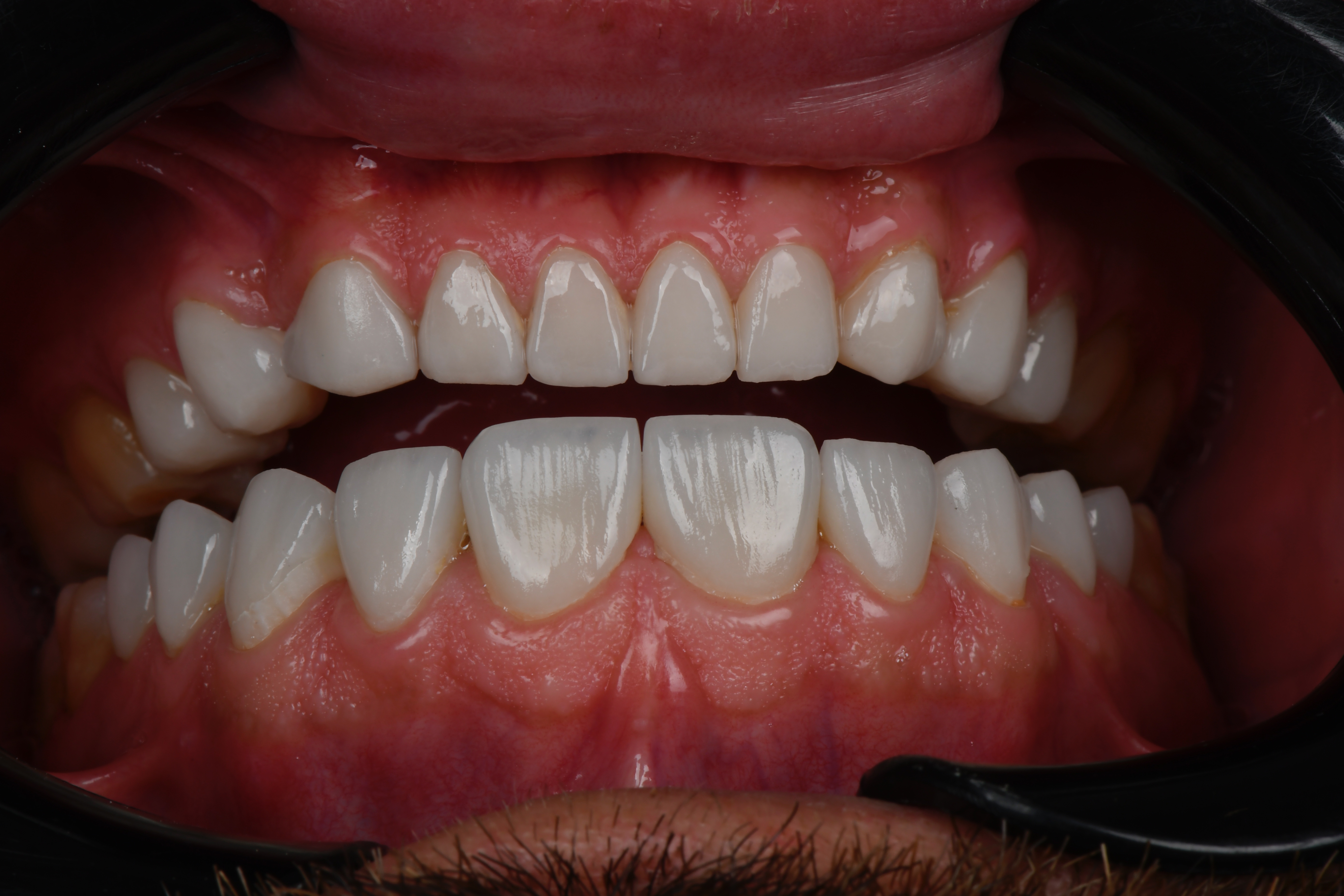 نمونه کار دکتر فاطمه فروزش — لیفت و لمینت مژه
